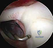 إدخال المنظار ورؤية المفصل من الداخل