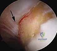 Intraoperative Surgical Step