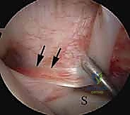 صورة توضيحية لـ منظار الكتف: دليلك الشامل لفهم الإجراء والتعافي مع الأستاذ الدكتور محمد هطيف