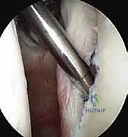 صورة توضيحية لـ منظار الكتف: دليلك الشامل لفهم الإجراء والتعافي مع الأستاذ الدكتور محمد هطيف