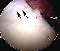 Shoulder Arthroscopy Masterclass: A Comprehensive Intraoperative Guide