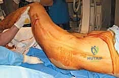 الأشعة السينية لكسر الفخذ قبل الجراحة