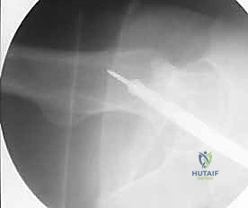 التصوير الشعاعي الدقيق للكسر