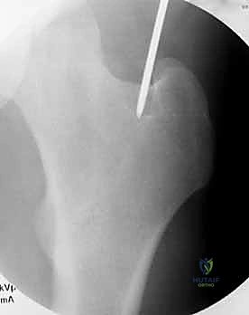 التخطيط الجراحي باستخدام الأشعة المقطعية