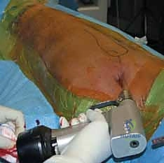 المسمار النخاعي كخيار ذهبي