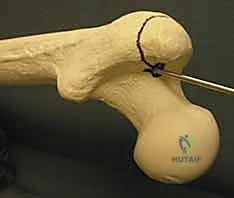 مسامير القفل العرضية لضمان الاستقرار