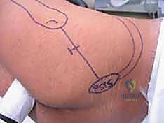 استخدام جهاز الأشعة C-arm في غرفة العمليات