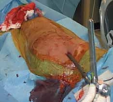 تحديد نقطة الإدخال التشريحية بدقة