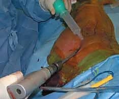 عملية توسيع القناة النخاعية