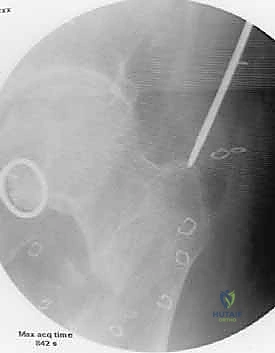 تثبيت كسر عظم الفخذ بالمسمار النخاعي الأمامي: دليل شامل لمرضى صنعاء