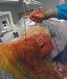 وضع مسامير القفل العلوية والسفلية