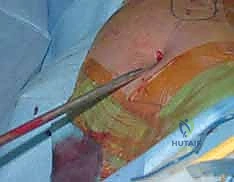 الدقة المتناهية في التثبيت الجراحي