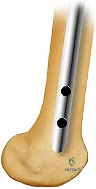 التورم والتشوه المصاحب لكسر الفخذ