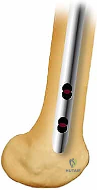 إدخال المسمار النخاعي داخل العظم