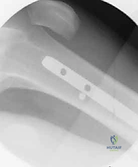 بدء العلاج الطبيعي والمشي المبكر