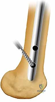 صورة شعاعية لحالة معقدة تم علاجها بنجاح