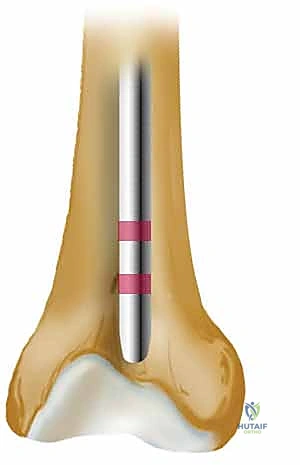 عودة المريض لممارسة حياته الطبيعية
