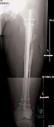 Illustration of anterograde intramedullary nailing - Dr. Mohammed Hutaif