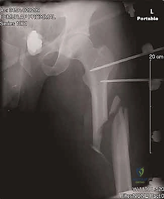 التئام العظم التام في الأشعة المتابعة