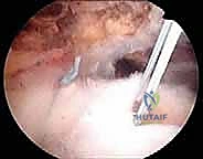 قصص نجاح مرضى جراحة الكتف مع الدكتور محمد هطيف