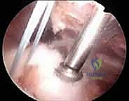 صورة توضيحية لـ إصلاح الكفة المدورة بالمنظار مزدوج الصفوف: استعادة قوة الكتف بلا ألم مع الأستاذ الدكتور محمد هطيف