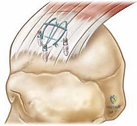 التشخيص الدقيق لتمزقات الكتف بالرنين المغناطيسي