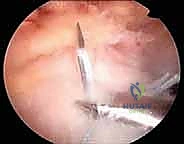 أسباب تمزق أوتار الكتف التنكسية والحادة