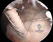 صورة توضيحية لـ إصلاح الكفة المدورة بالمنظار مزدوج الصفوف: استعادة قوة الكتف بلا ألم مع الأستاذ الدكتور محمد هطيف