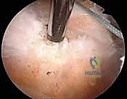 برنامج التأهيل والعلاج الطبيعي بعد جراحة الكتف - المرحلة الأولى