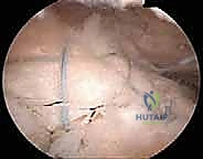 تمارين استعادة المدى الحركي للكتف بعد الجراحة