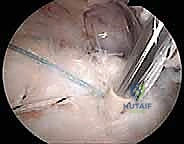 تحضير المريض وتجهيز غرفة العمليات لجراحة الكتف