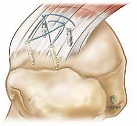 خطوات تثبيت الأوتار بتقنية مزدوج الصفوف