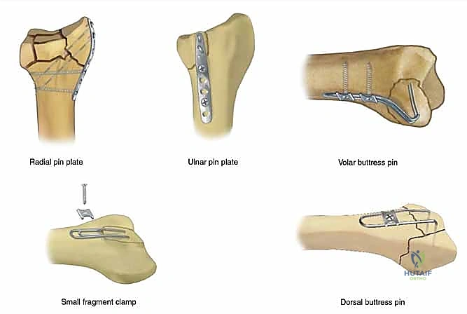 صورة طبية: تثبيت كسور عظم الكعبرة البعيدة المتناسب مع الشظايا: دليل شامل للمرضى مع الأستاذ الدكتور محمد هطيف