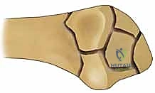 استخدام أحدث التقنيات في جراحة عظام الرسغ في اليمن