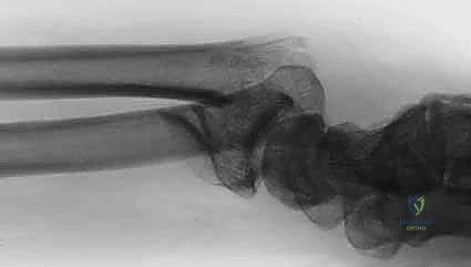 تثبيت شظية العمود الكعبري بدقة متناهية