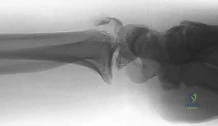 تثبيت الزاوية الزندية لضمان حركة دوران الساعد