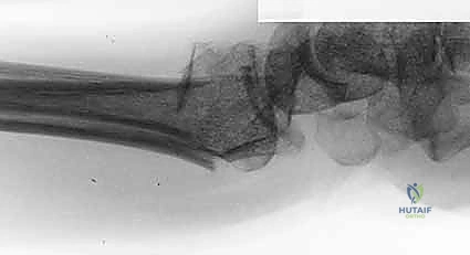 التعامل مع الحافة الأمامية للوجه الهلالي جراحياً