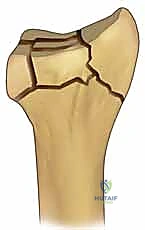 Fragment-Specific Fixation of Distal Radius Fractures: An Intraoperative Masterclass