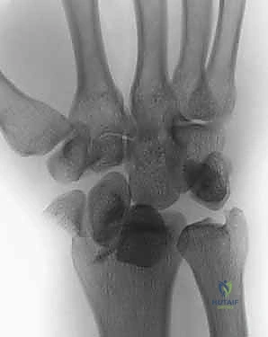 إصابات الرسغ عالية الطاقة وتأثيرها على العظام