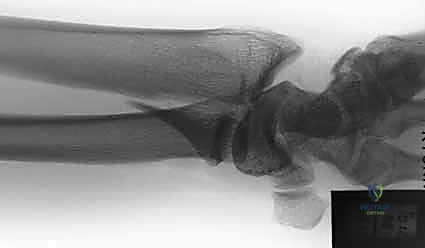 إعادة بناء الجدار الظهري لمنع تمزق الأوتار