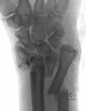 التخطيط الجراحي باستخدام الأشعة المقطعية ثلاثية الأبعاد