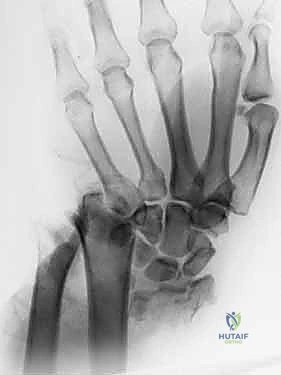 التعامل مع الشظايا المفصلية الحرة بتقنيات الجراحة الميكروسكوبية