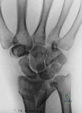 صور الأشعة السينية الأولية لتقييم الكسر