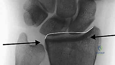 مقارنة الغرسات الجراحية وإظهار التفوق التقني