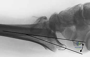 صورة توضيحية لـ تثبيت كسور عظم الكعبرة البعيدة المتناسب مع الشظايا: دليل شامل للمرضى مع الأستاذ الدكتور محمد هطيف
