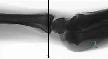 تثبيت كسور عظم الكعبرة البعيدة المتناسب مع الشظايا: دليل شامل للمرضى مع الأستاذ الدكتور محمد هطيف