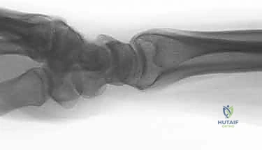 صورة طبية: تثبيت كسور عظم الكعبرة البعيدة المتناسب مع الشظايا: دليل شامل للمرضى مع الأستاذ الدكتور محمد هطيف