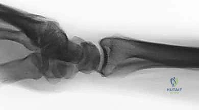 صورة طبية: تثبيت كسور عظم الكعبرة البعيدة المتناسب مع الشظايا: دليل شامل للمرضى مع الأستاذ الدكتور محمد هطيف