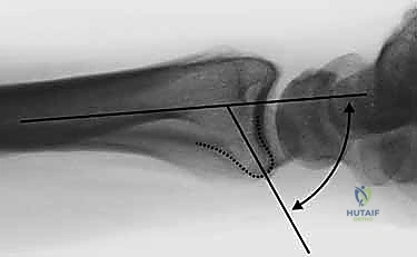 صورة توضيحية لـ تثبيت كسور عظم الكعبرة البعيدة المتناسب مع الشظايا: دليل شامل للمرضى مع الأستاذ الدكتور محمد هطيف