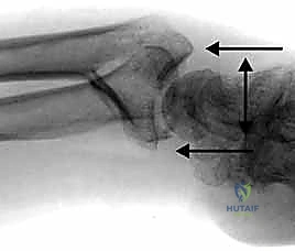 صورة طبية: تثبيت كسور عظم الكعبرة البعيدة المتناسب مع الشظايا: دليل شامل للمرضى مع الأستاذ الدكتور محمد هطيف
